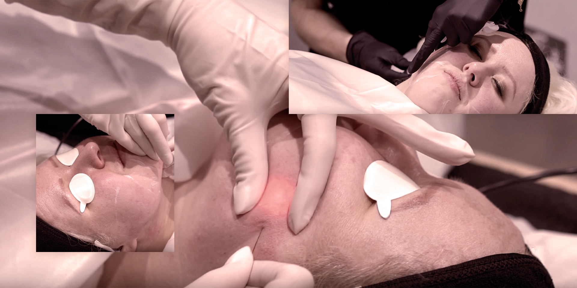 The Endolift® Edit: How This Precision Laser is Redefining Skin Tightening