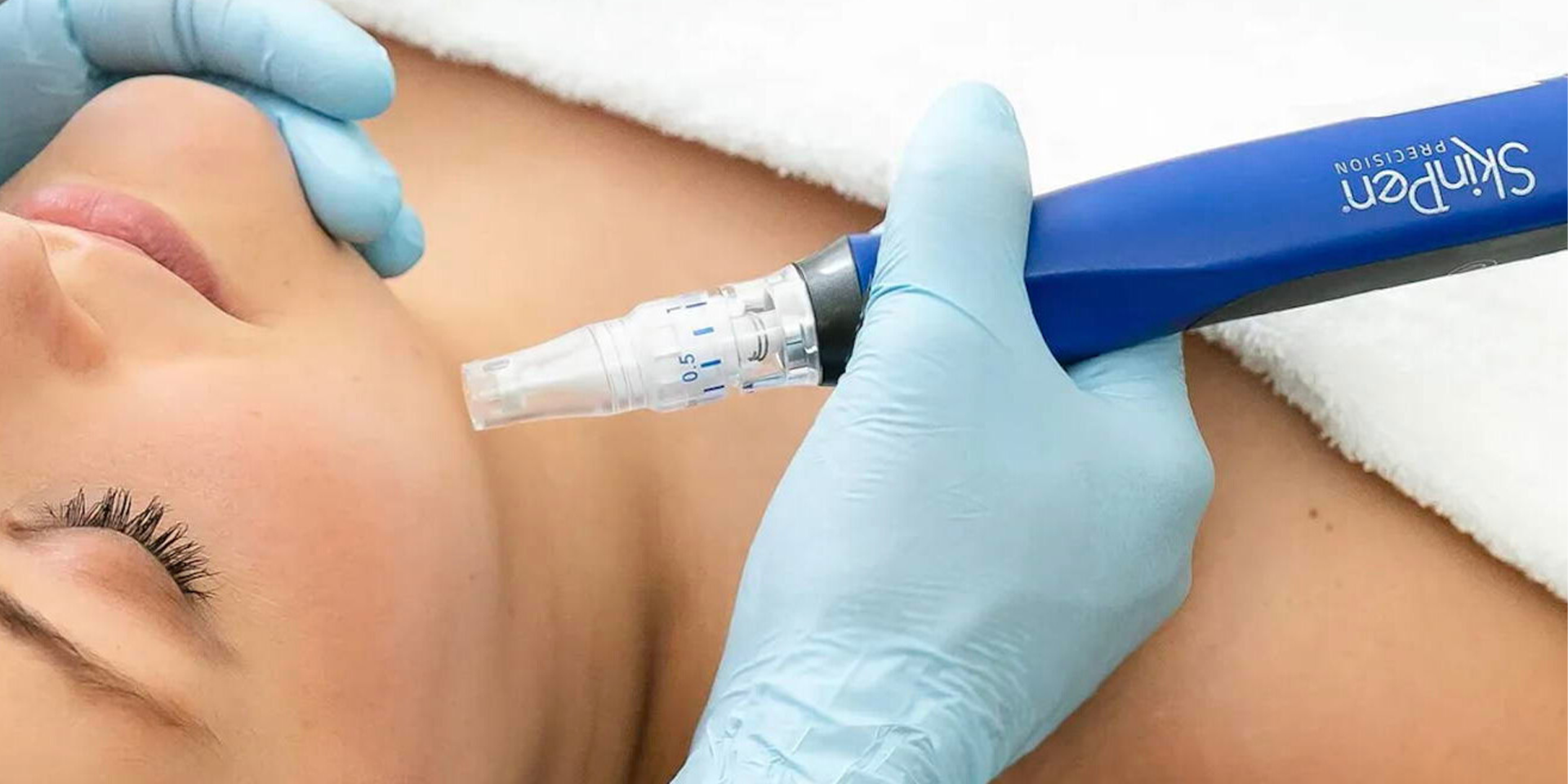 Will Microneedling Help with Acne Scars?