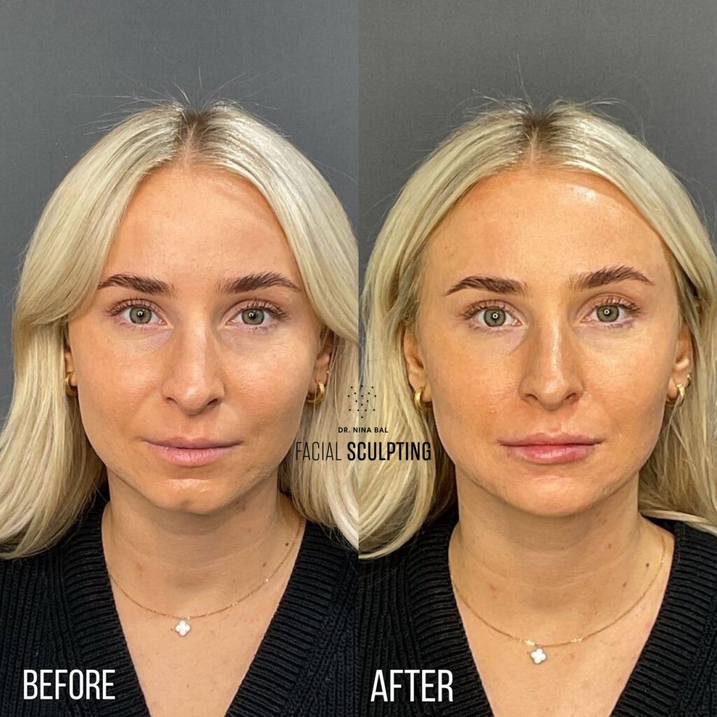 Chin Sculpting before and after results