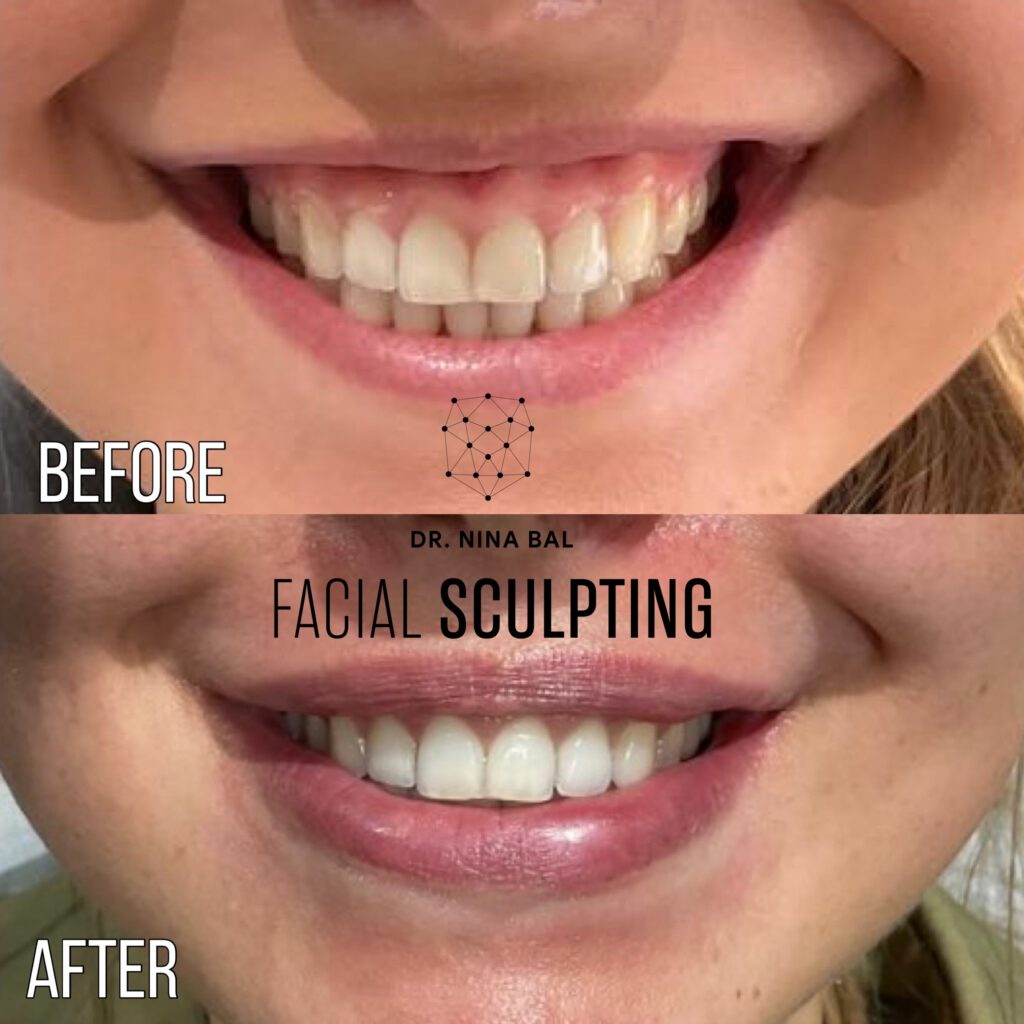 Lip Enhancement before and after results