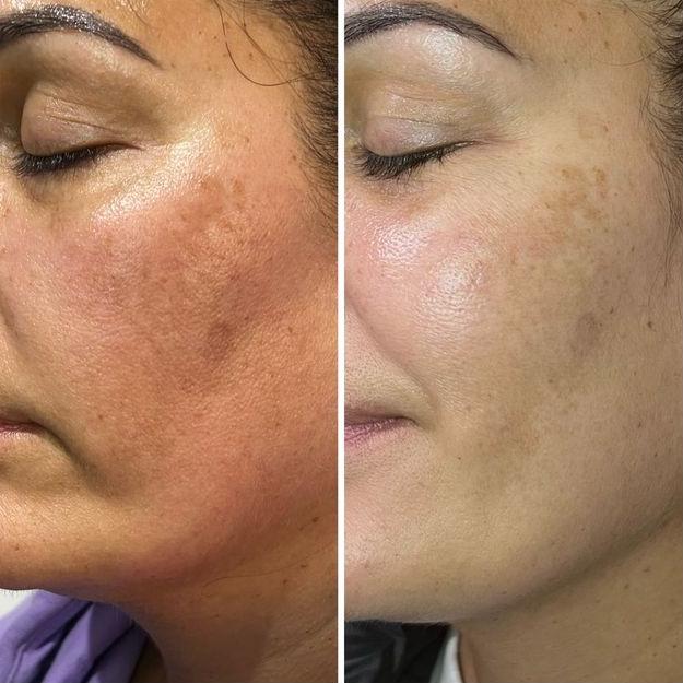 Dermalux LED before and after results