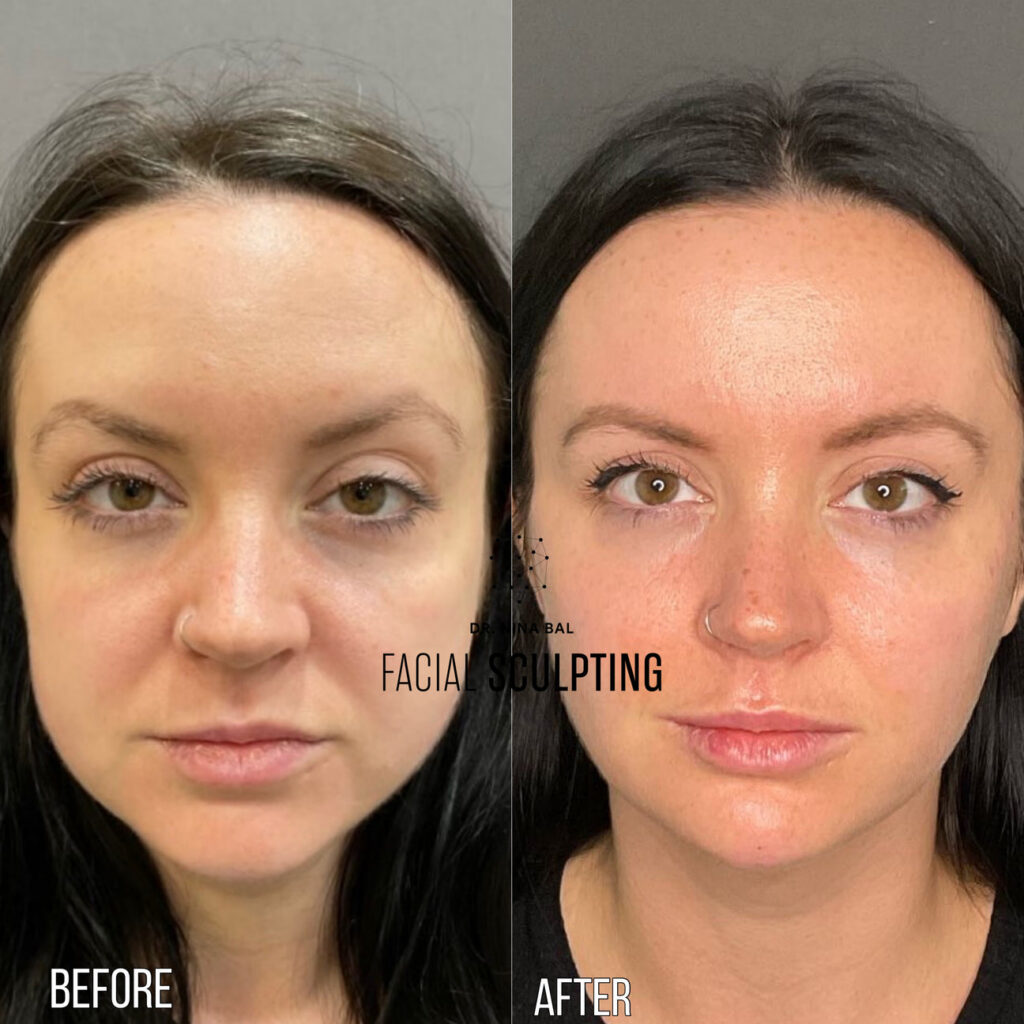 Endolift® In London before and after results