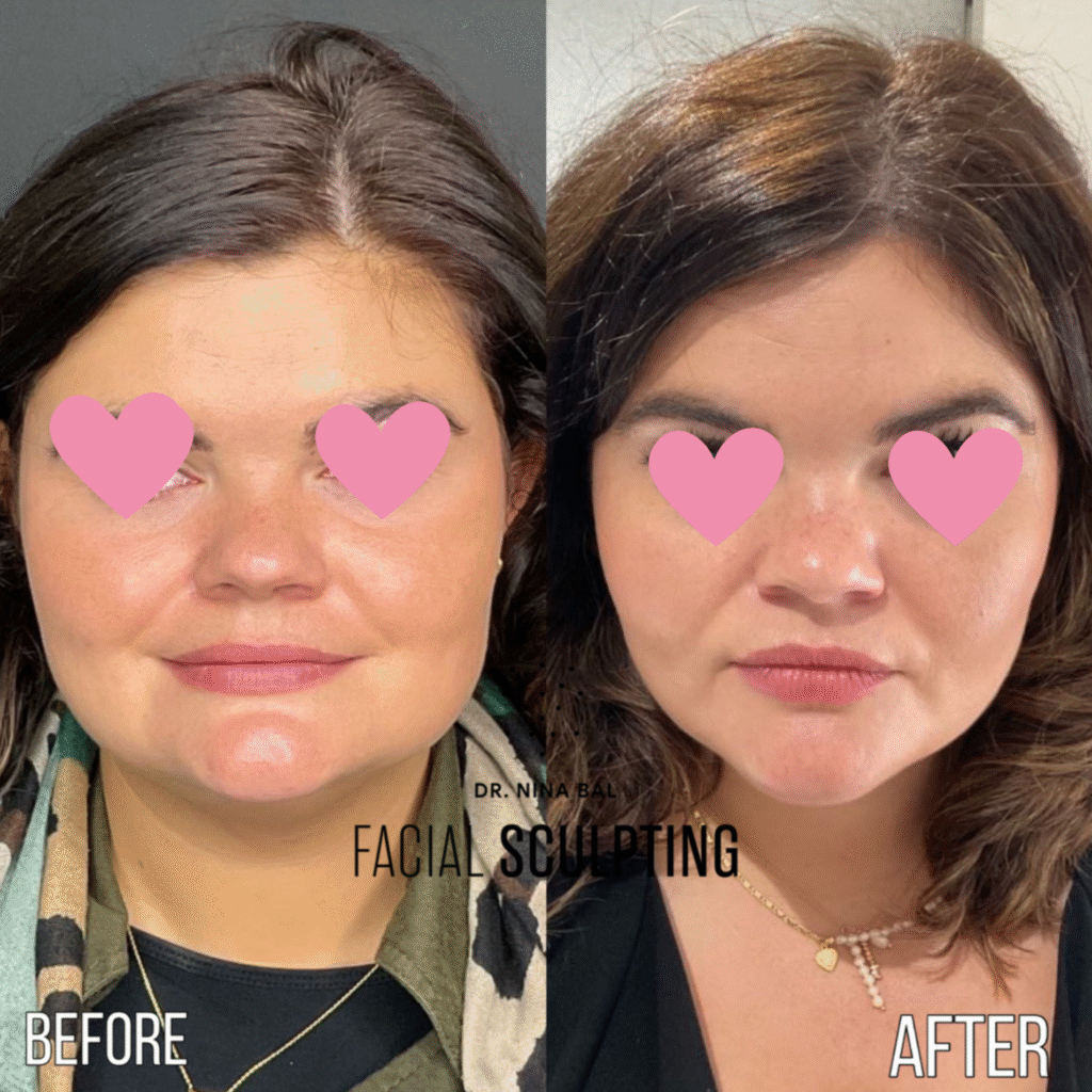 Jawline Slimming before and after results